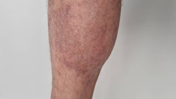 Autoimmune Diseases